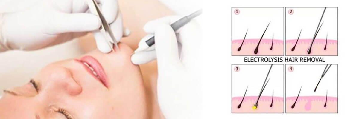 Electrolysis Permanent Hair Removal for Unwanted Hair