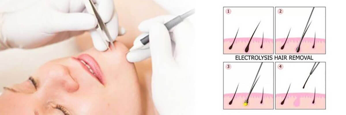 Electrolysis 100% Permanent hair removal