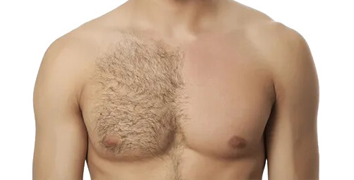 Electrolysis for men and Athletes 100 Permanent Hair Removal