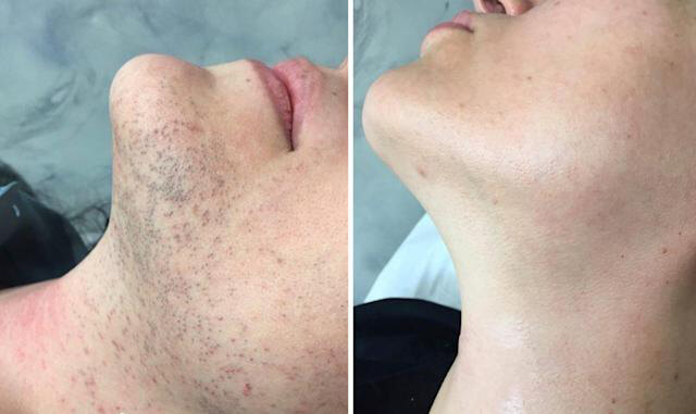 electrolysis scar removal