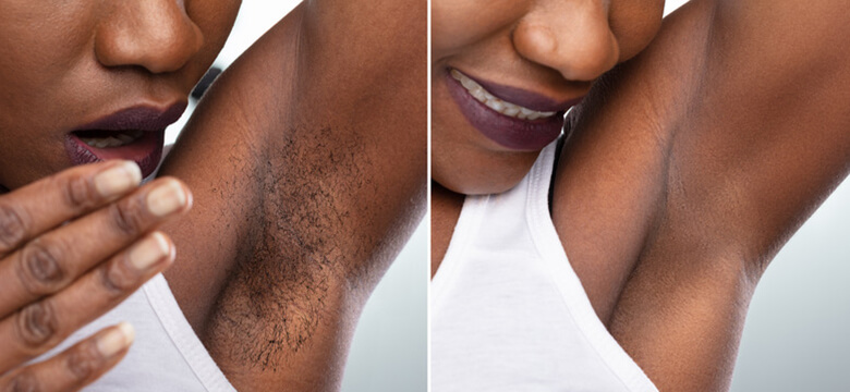 Electrolysis for Dark Skin