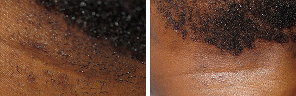 Electrolysis for Dark Skin