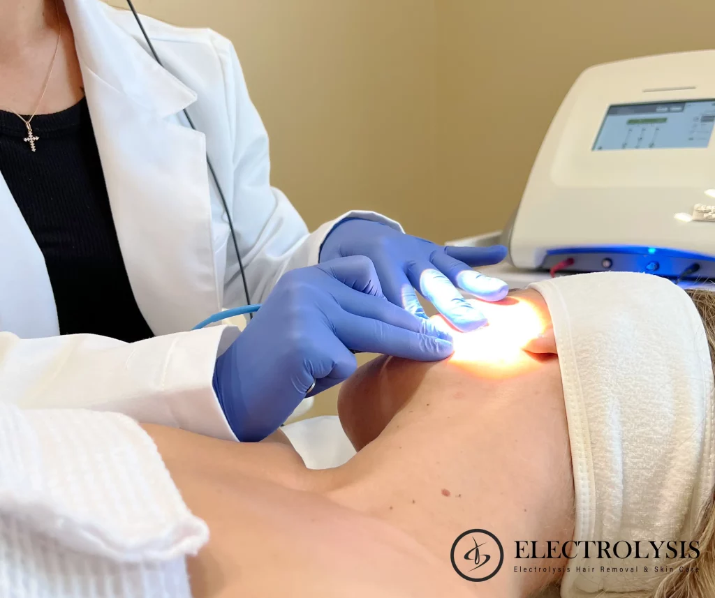 Electrolysis Hair Removal for PCOS Chicago