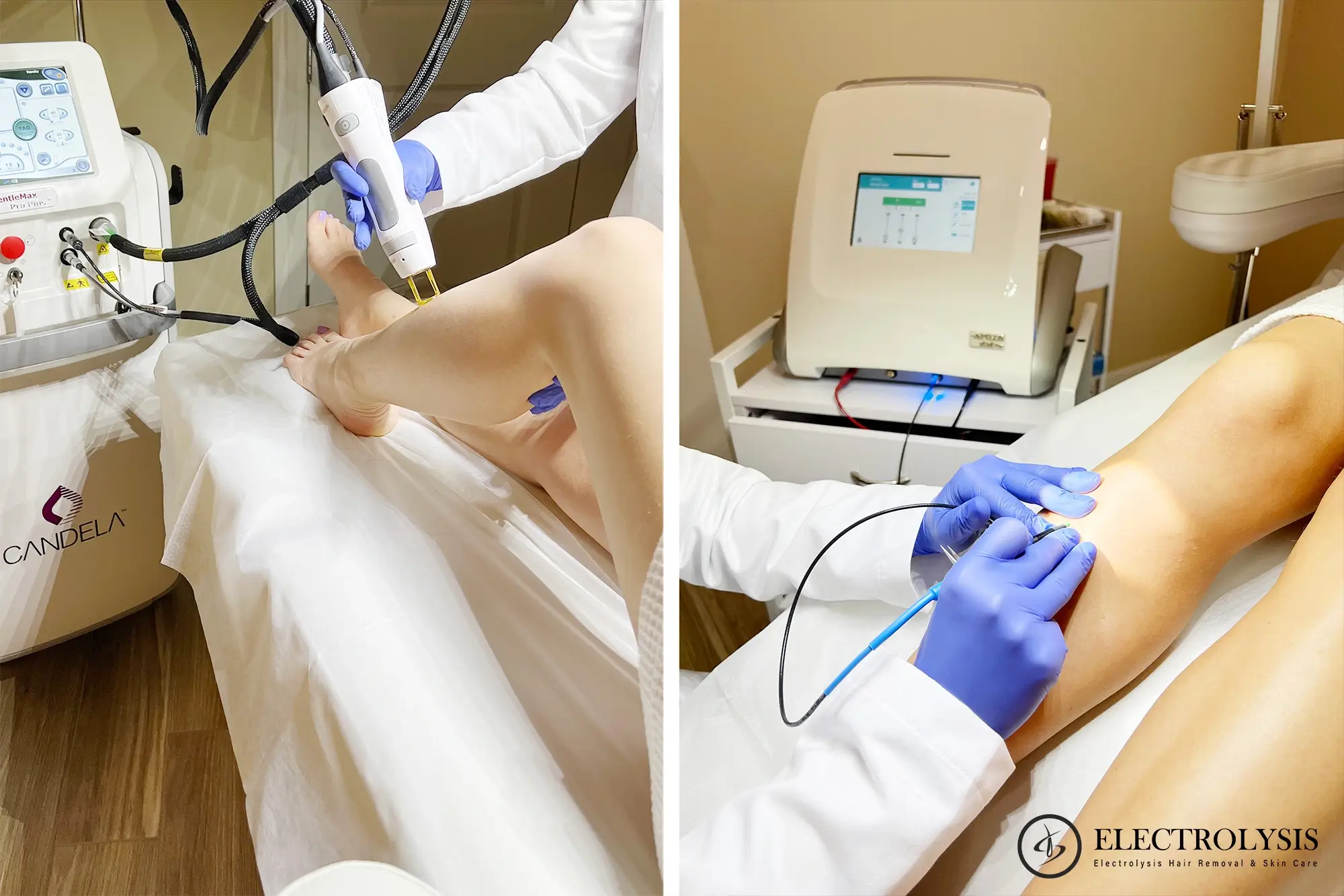 Electrolysis vs laser hair removal comparison at our Chicago permanent hair removal clinic
