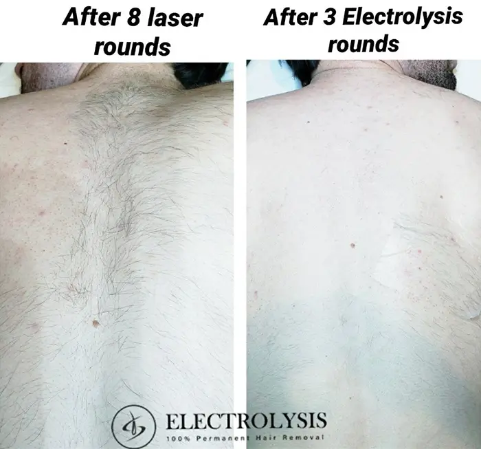 Electrolysis Before and After 100 Permanent Hair Removal