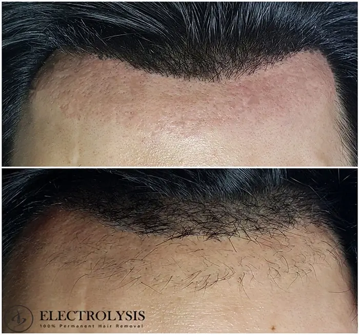 Electrolysis Hair Removal