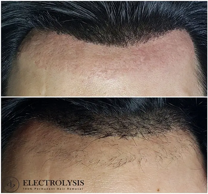 Electrolysis Before and After 100 Permanent Hair Removal