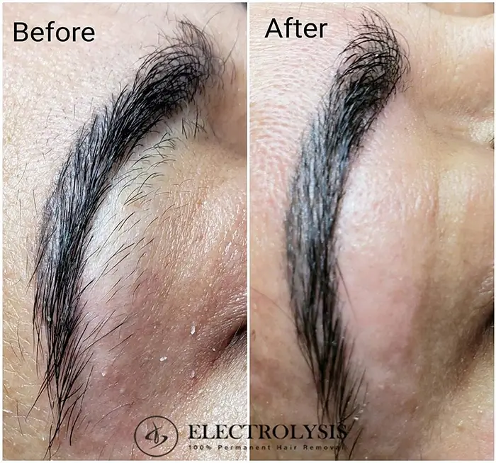 Electrolysis Hair Removal