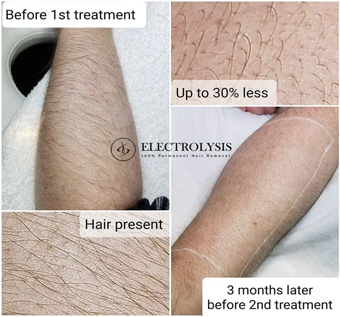 Electrolysis Before and After 100 Permanent Hair Removal