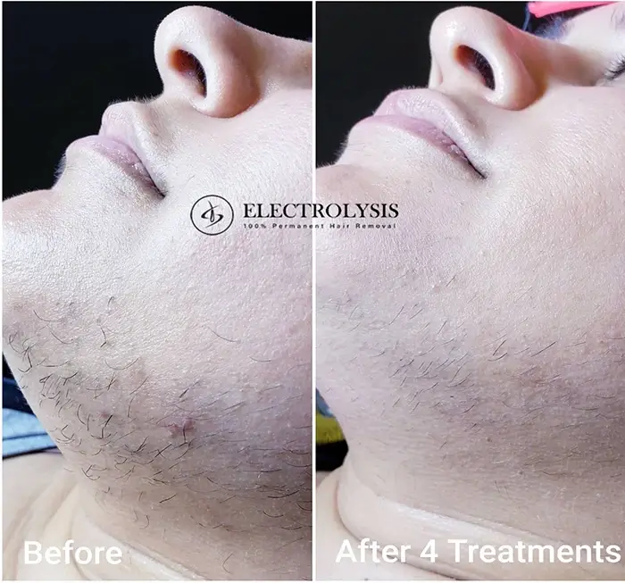 Electrolysis Hair Removal