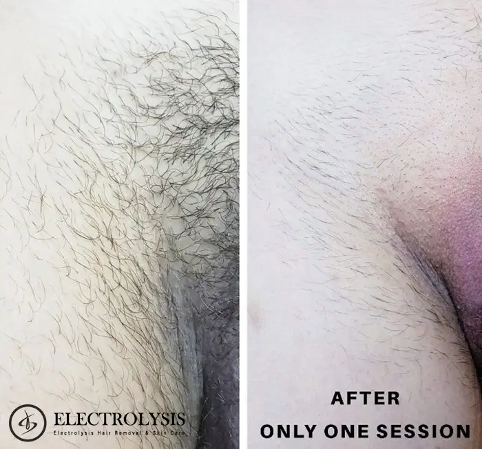 Electrolysis Before and After 100 Permanent Hair Removal