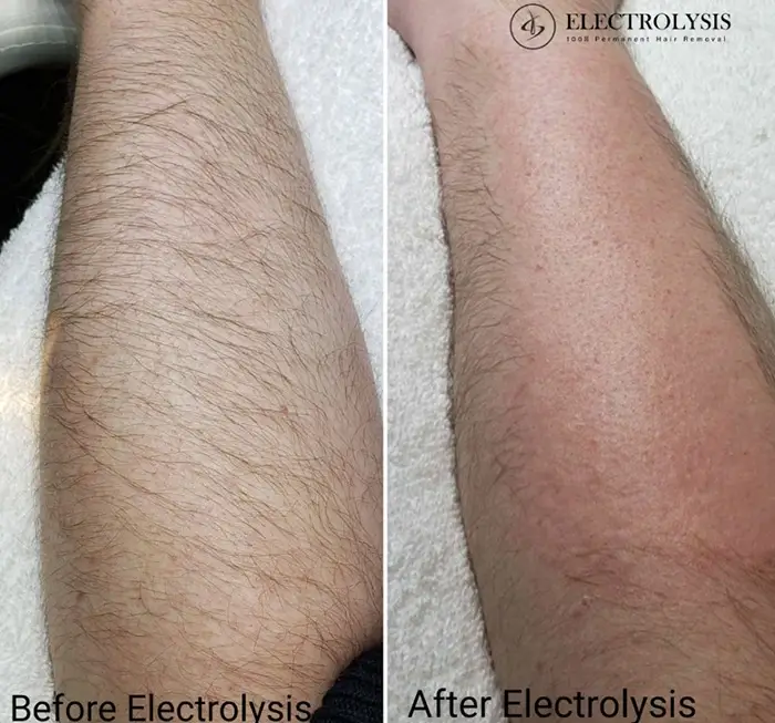 Electrolysis Hair Removal