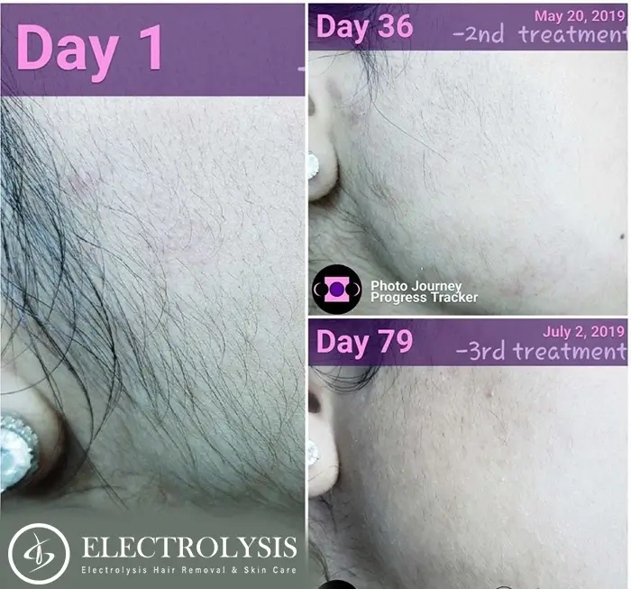 Electrolysis Before and After