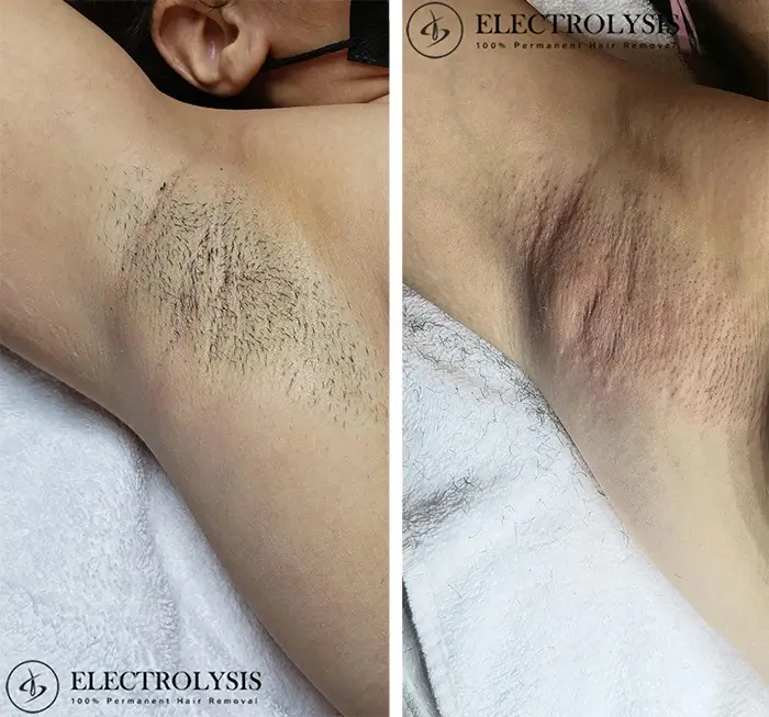 Electrolysis Before and After 100 Permanent Hair Removal