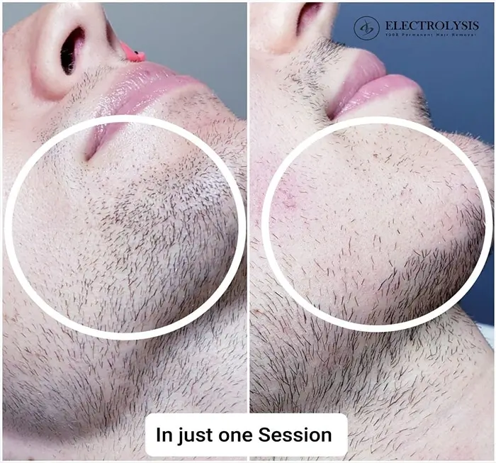 Electrolysis Before and After 100 Permanent Hair Removal