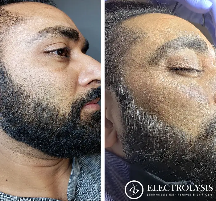 Electrolysis Before and After 100 Permanent Hair Removal