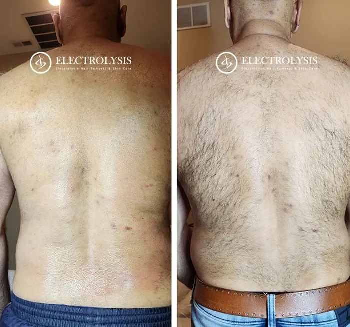 Electrolysis Before and After 100 Permanent Hair Removal