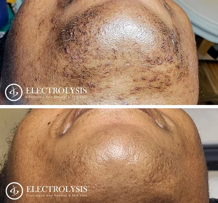 electrolysis before and after