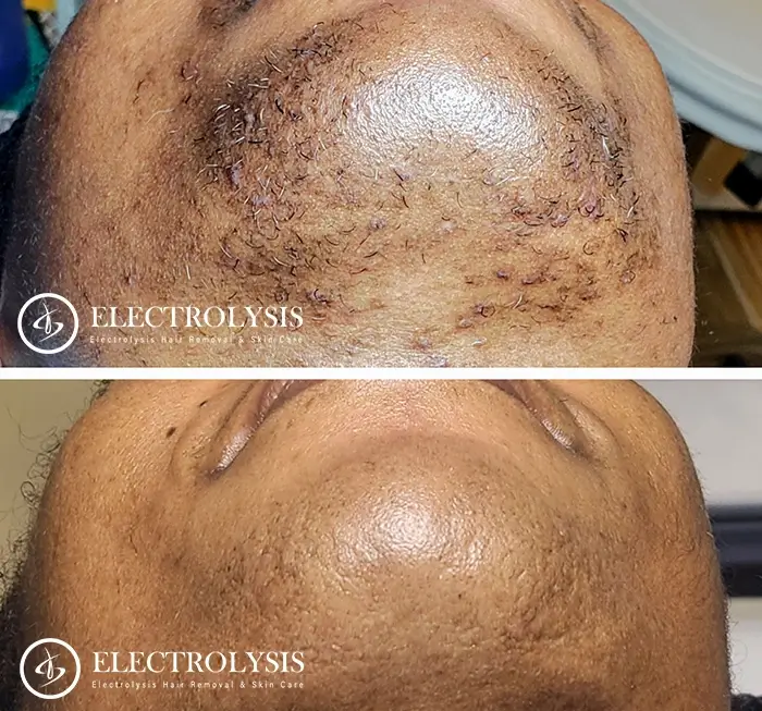 Electrolysis Hair Removal Results Deals | vivatumusica.com