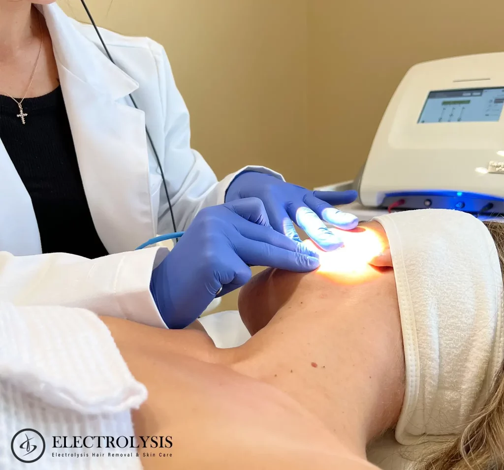 traditional electrolysis hair removal