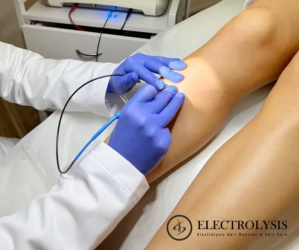 Is electrolysis hair removal covered by insurance