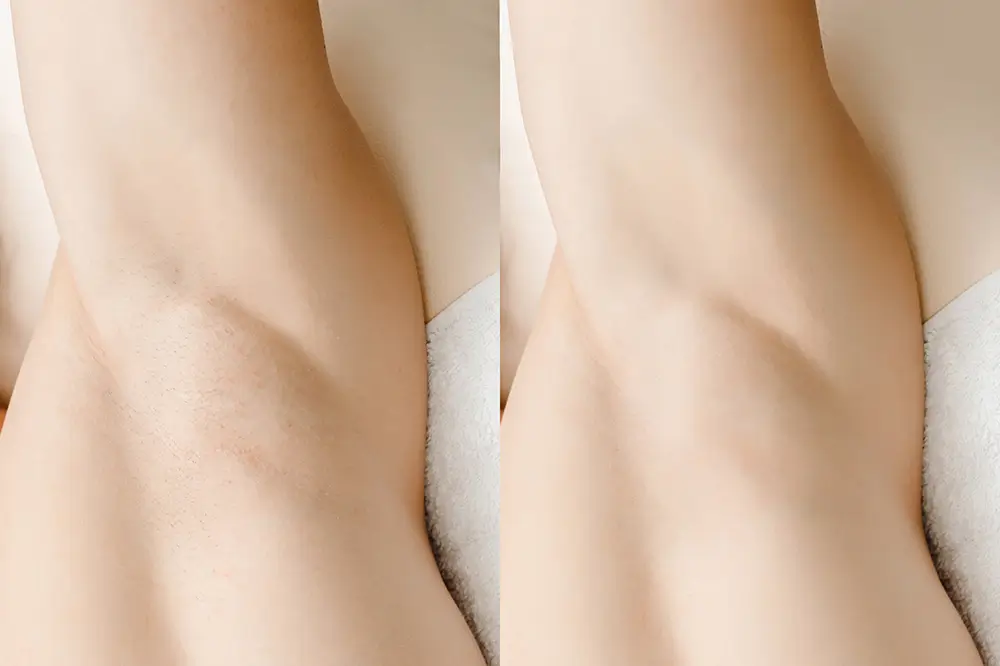 before and after electrolysis hair removal