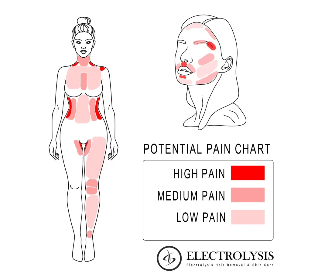Body and facial electrolysis pain chart