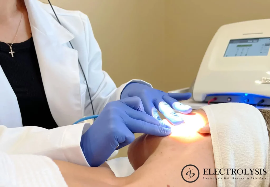 electrolysis hair removal