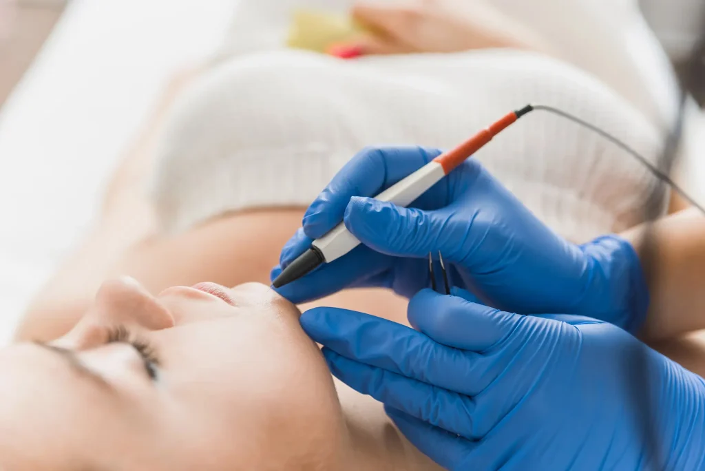 How Much Hair Can Electrolysis Remove