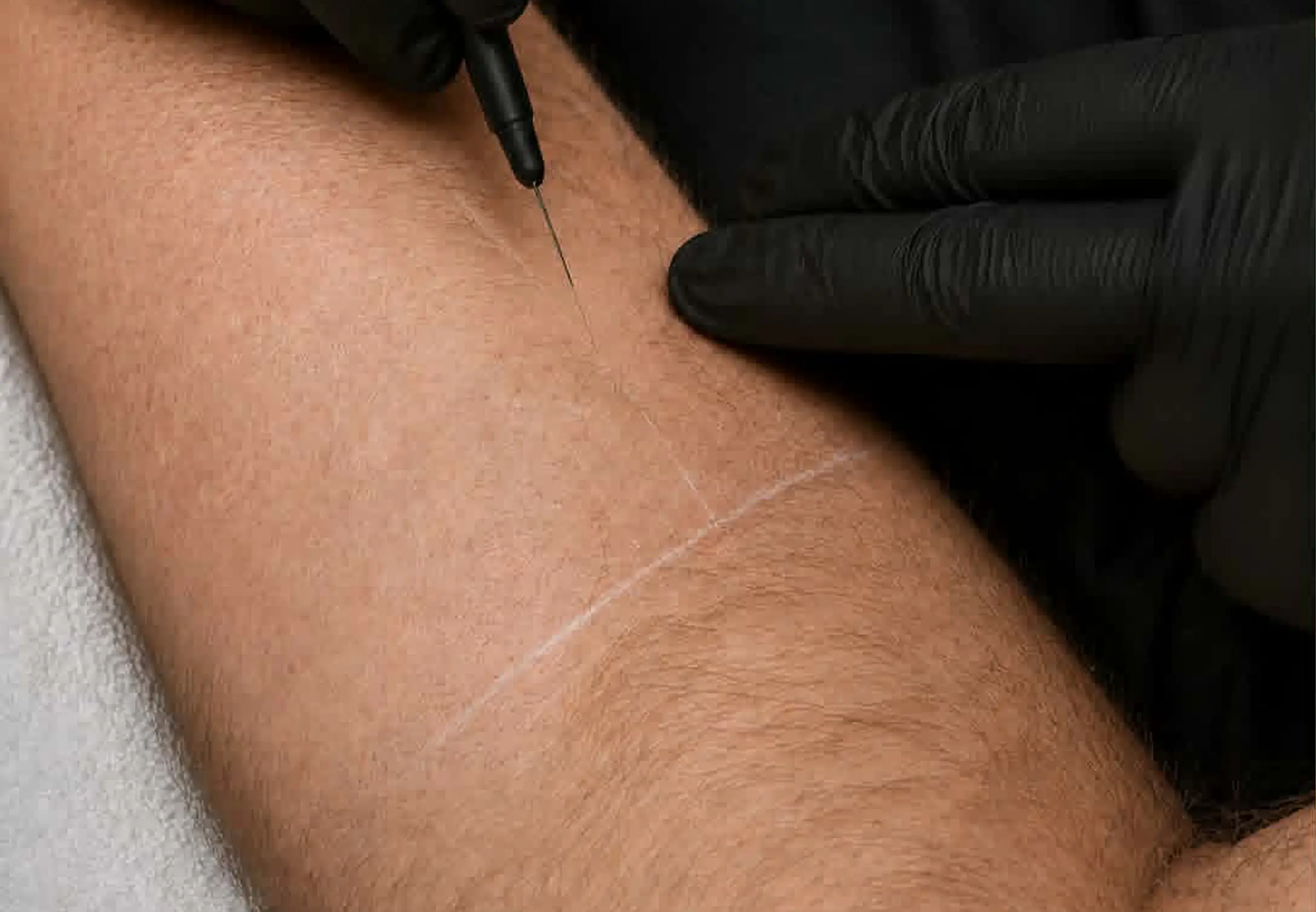 ftm electrolysis hair removal