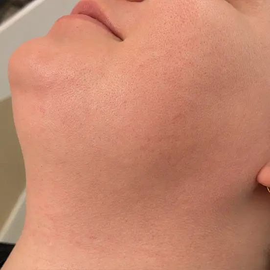 Face after MtF transgender facial electrolysis in Chicago