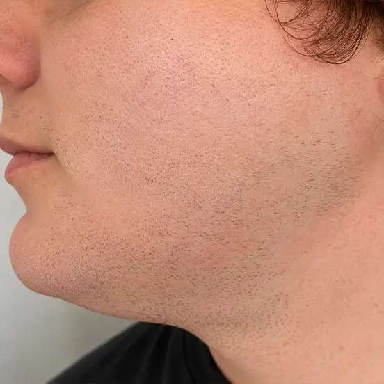 Facial hair before transgender electrolysis hair removal