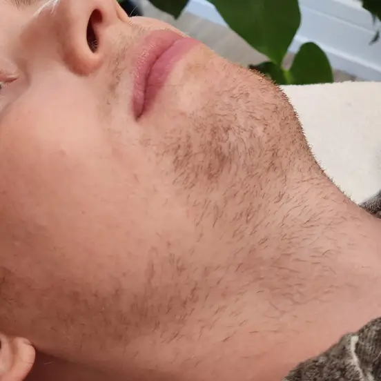 Beard before MtF facial electrolysis permanent hair removal in Chicago