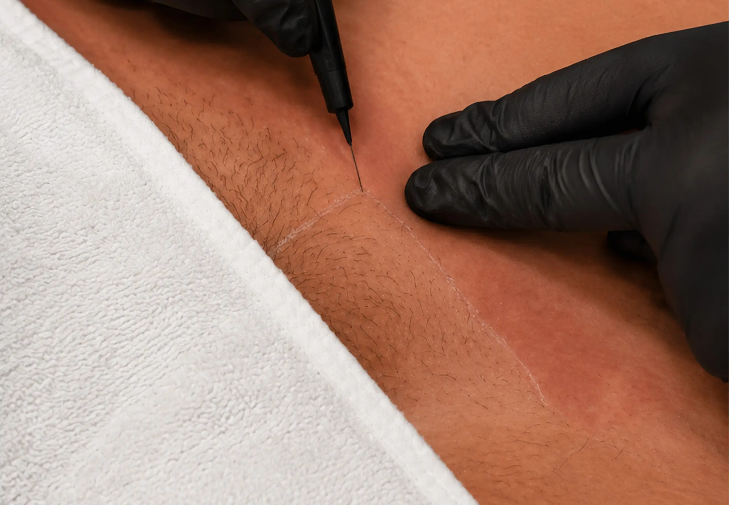 Pre-surgical MtF genital electrolysis permanent hair removal in Chicago