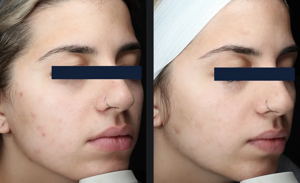 Young woman with congested, breakout-prone skin before and after one Glacē facial