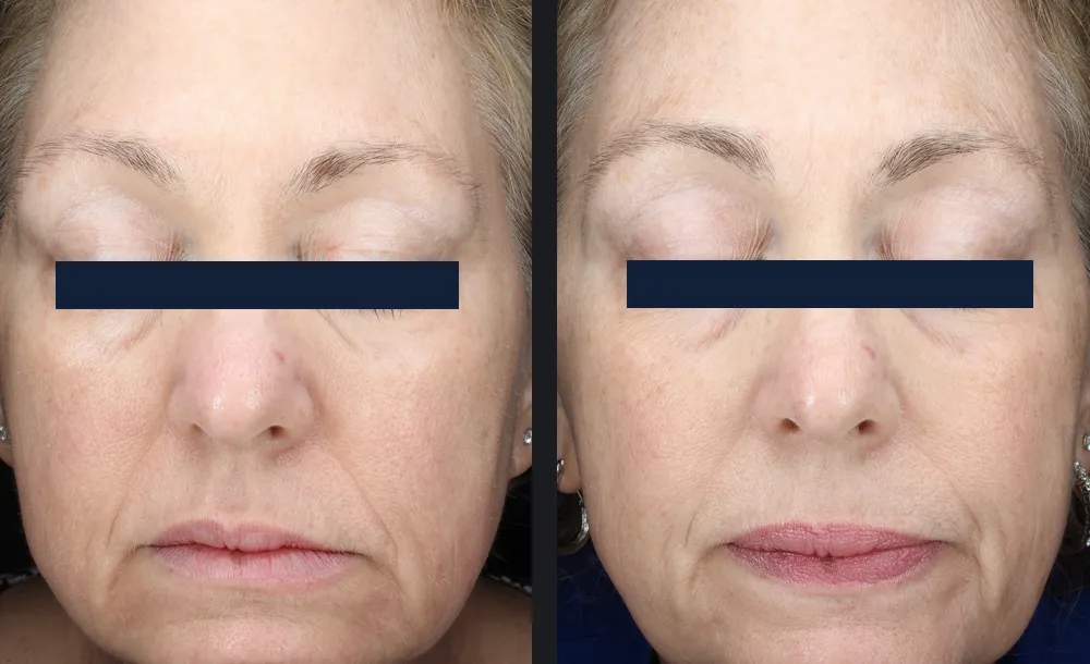 Mature woman before and after a series of Glacē facials, with smoother, brighter skin