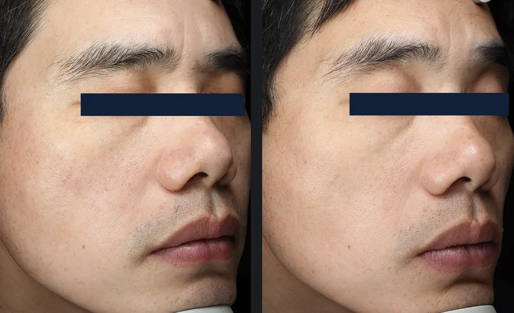 Man before and after a series of Glacē facials, with refined pores and a more even skin tone