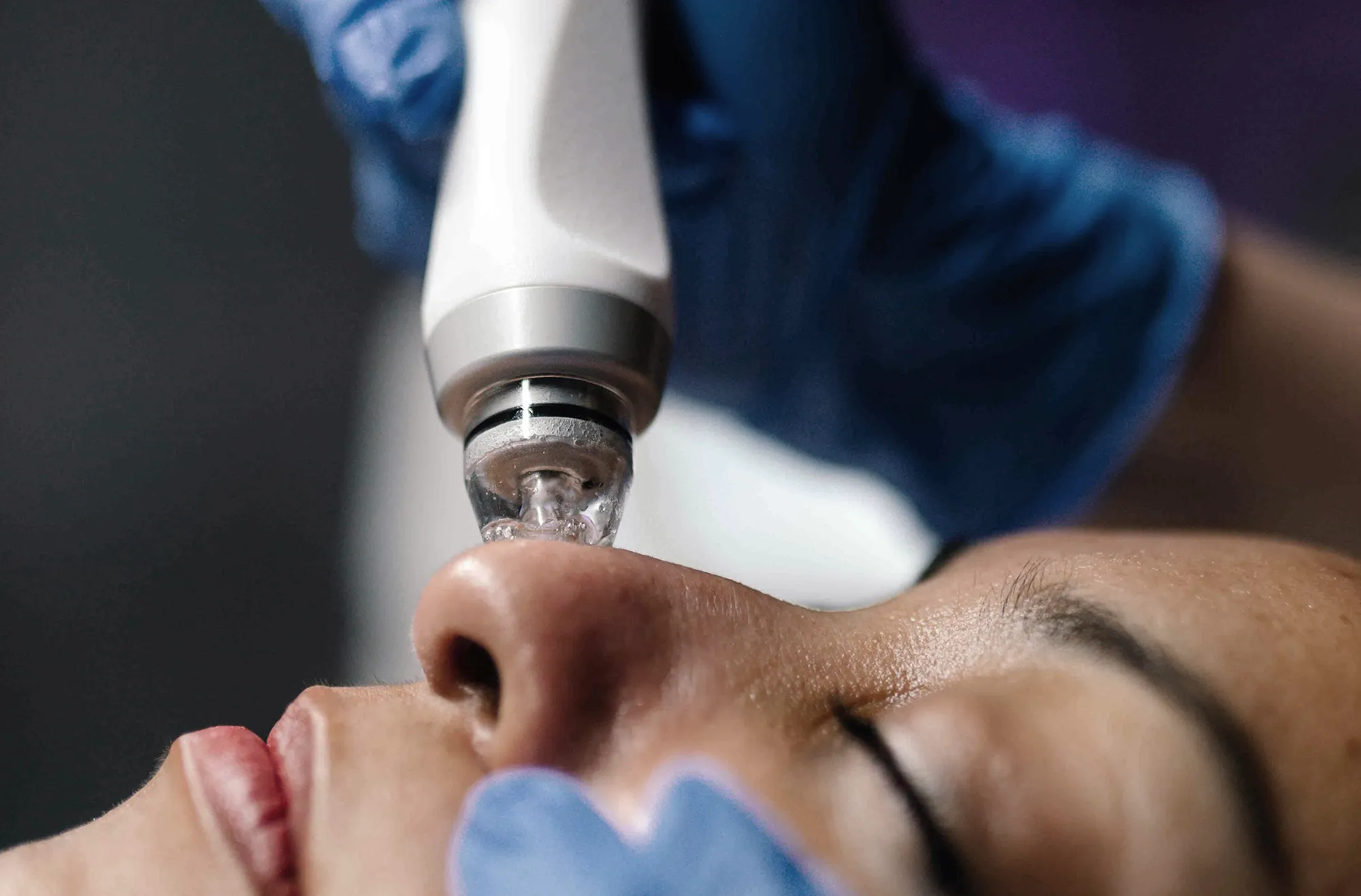 Candela Glacē diamond-tip handpiece exfoliating and infusing serum during a glass skin facial in Chicago
