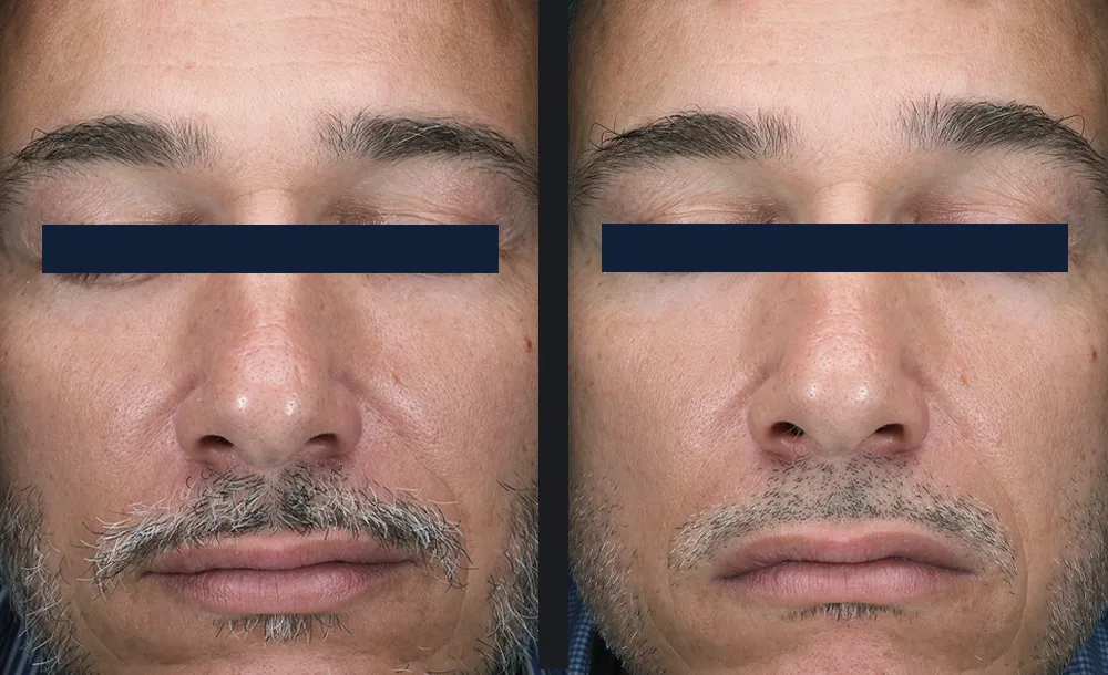 Man before and after one Glacē facial, with refreshed, more hydrated-looking skin