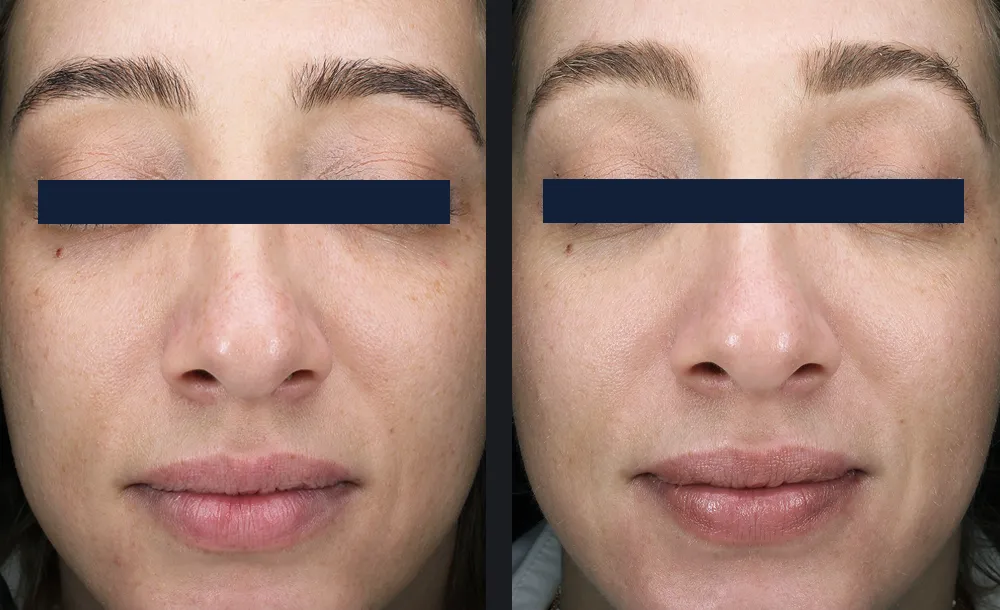 Woman before and after one Glacē facial, with smoother, brighter and more even-looking skin