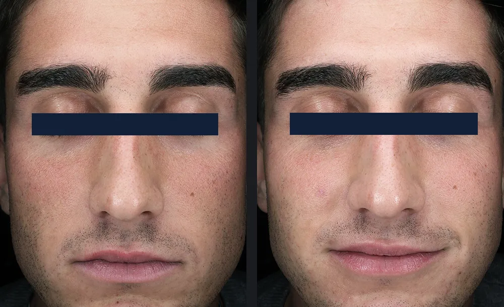 Young man before and after one Glacē facial, with less redness and a clearer complexion